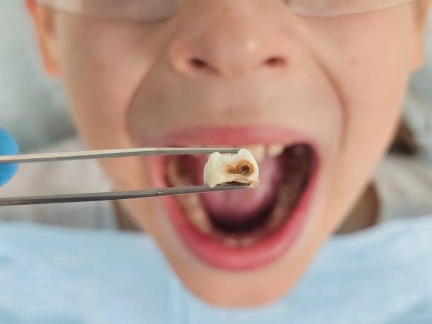Best Dentist for Tooth Abscess  in Peru, IL